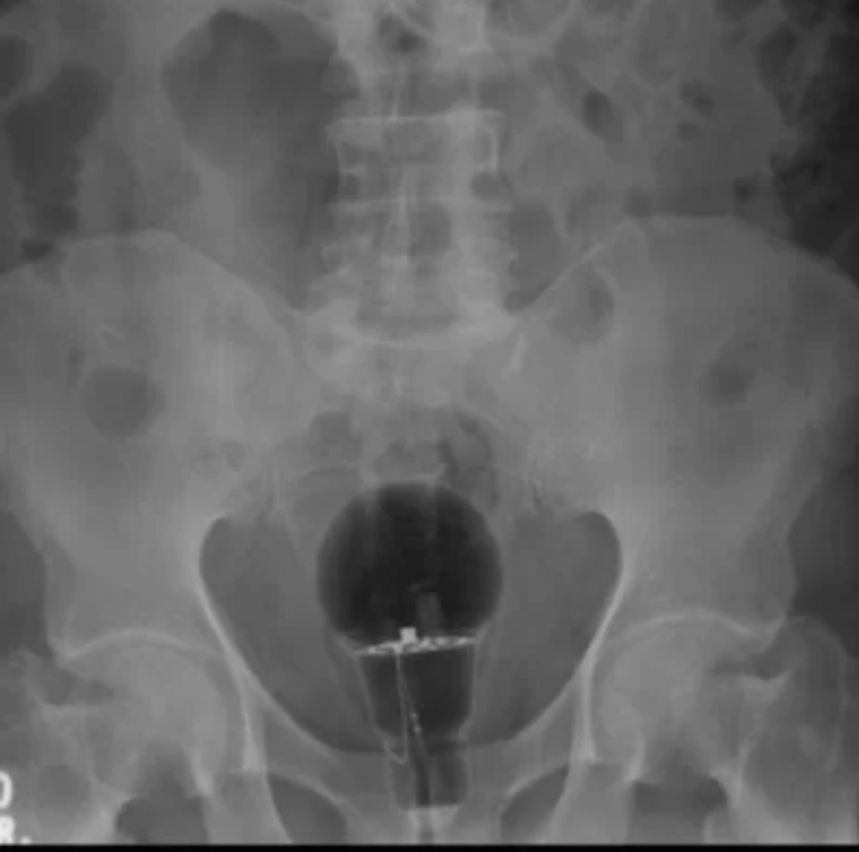  Um homem, de 53 anos, precisou passar por um procedimento às pressas após dar entrada em hospital com uma lâmpada dentro do ânus. 