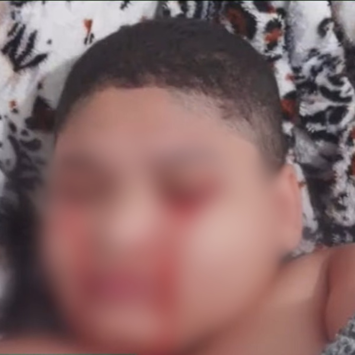  Um menino de 10 anos, morador de Cabo de Agostinho, no Recife, tem chamado atenção na região após desenvolver um quadro de saúde que o faz chorar sangue. 