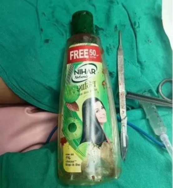 O caso de um homem de 55 anos que teve uma garrafa de óleo de cabelo retirado do estômago chamou atenção dos médicos do do estado de Madhya Pradesh, na Índia.