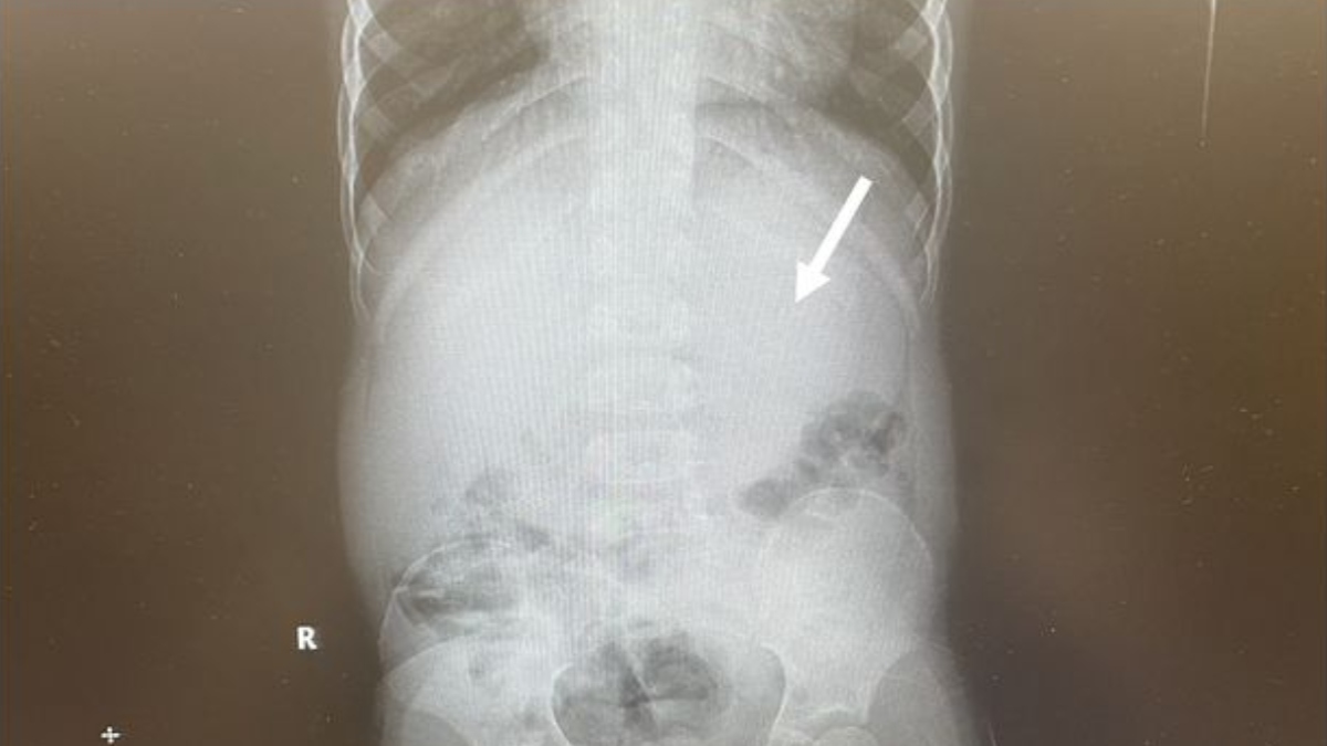  menino-engole-40-chiclete-cirurgia-emergencia 