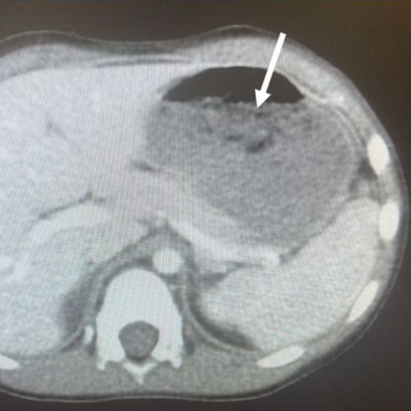 menino-engole-40-chiclete-cirurgia-emergencia