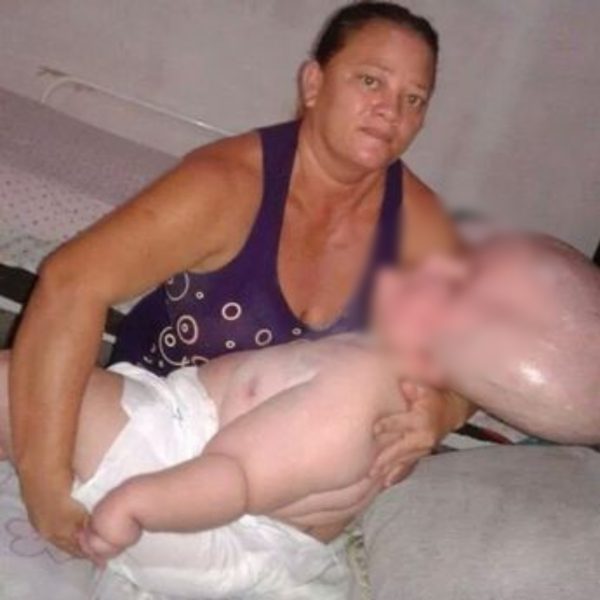 Mulher com hidrocefalia e expectativa de 3 anos de vida já tem 29 anos