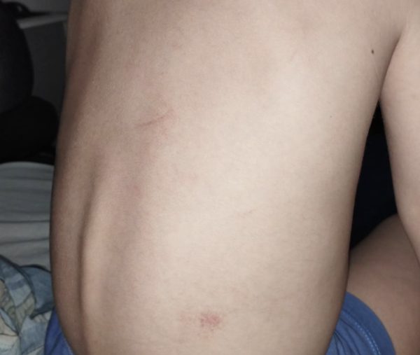 hematomas