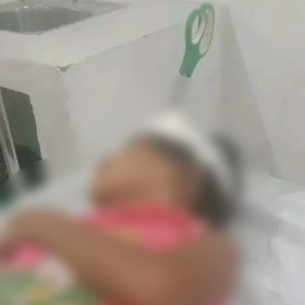 Criança finca tesoura na cabeça da irmã de 9 anos durante briga
