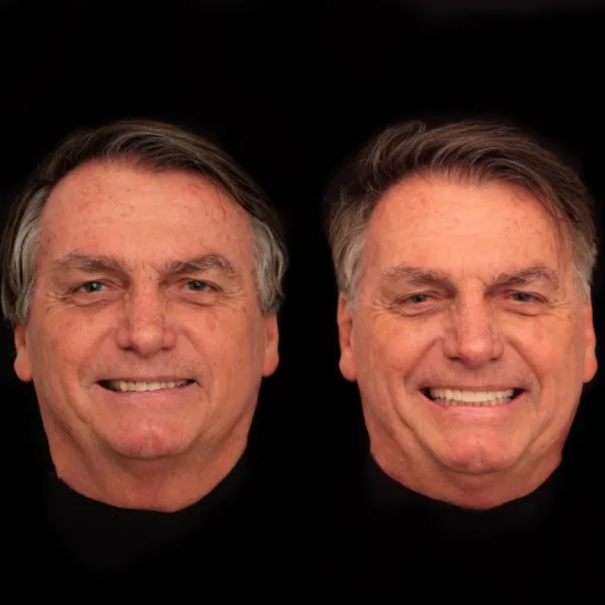  Bolsonaro gasta mais de R$ 84 mil com harmonização facial; veja como ficou 