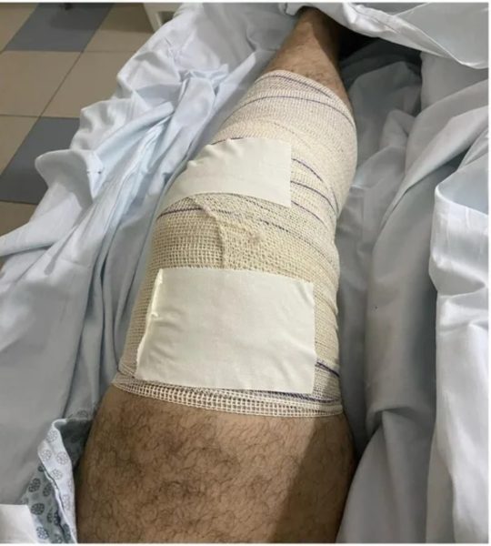 A cirurgia aconteceu no sábado (12) e a operação foi feita na perna correta.