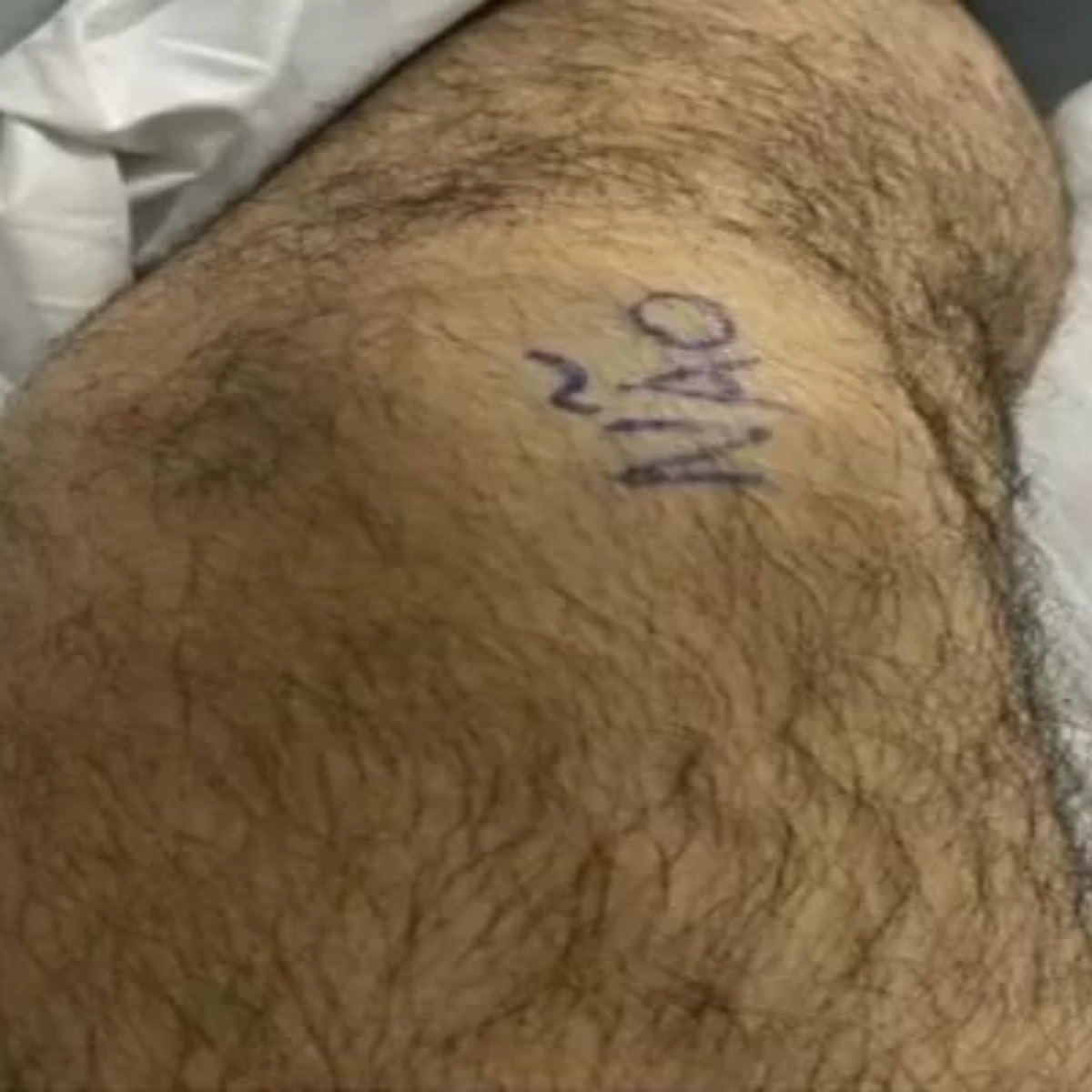  Homem marca joelho com 'sim' e 'não' para evitar erro médico em cirurgia 
