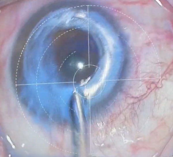 homem-procedimento-mudar-cor-olhos-viraliza