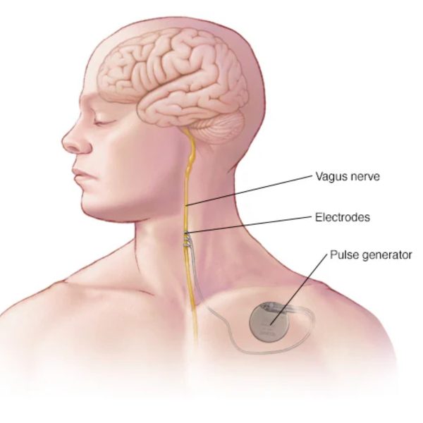 implante cerebral depressão - aparelho de estimulação do nervo vago