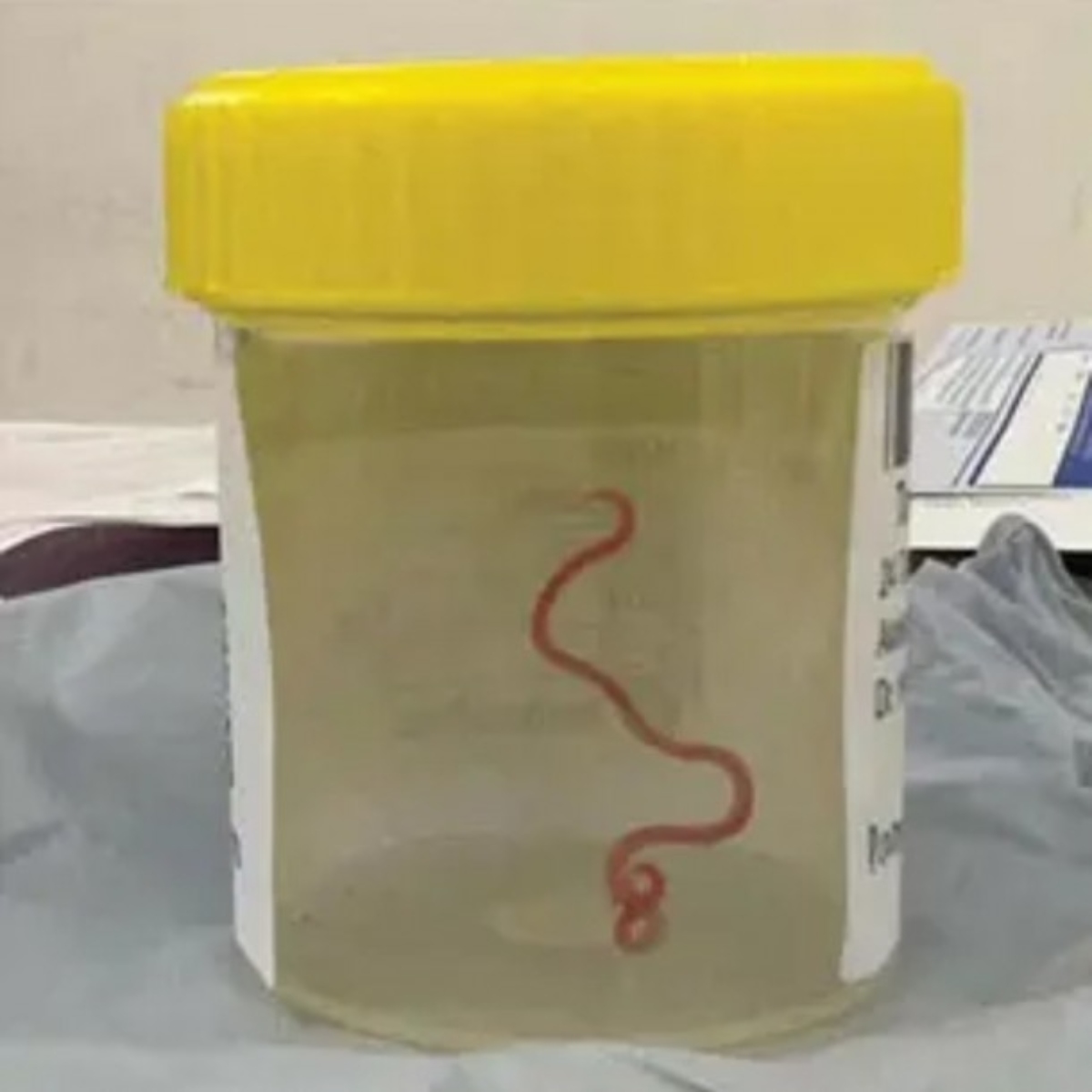  Uma mulher de 64 anos se tornou a primeira pessoa diagnosticada com um verme raro 