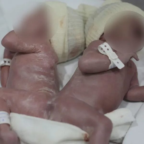 Os bebês nasceram por meio de parto cesárea e, juntos, pesam 3,360 quilos