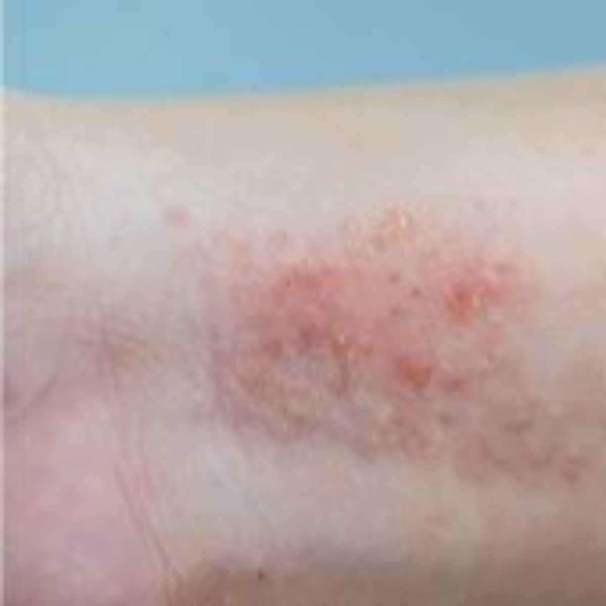  Dermatite pode causar vermelhidão, coceira e feridas na pele. 