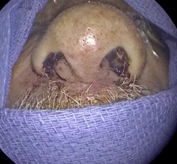 nariz de homem após remoção de larvas