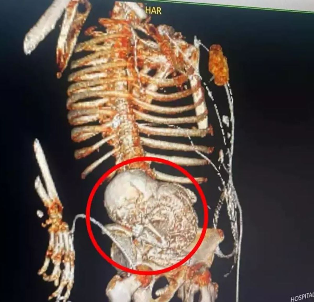  tomografia 3D mostrando feto 'mumificado' 