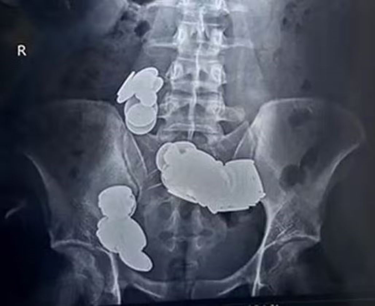 raio-x paciente com moedas no intestino