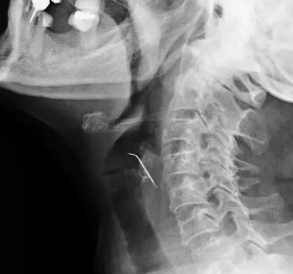  raio-x de garganta de mulher com prego alojado 