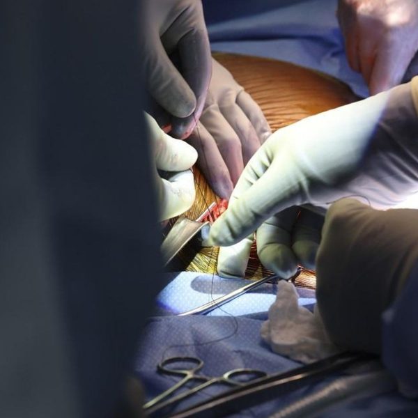 Médico brasileiro lidera primeiro transplante com rim de porco em humano