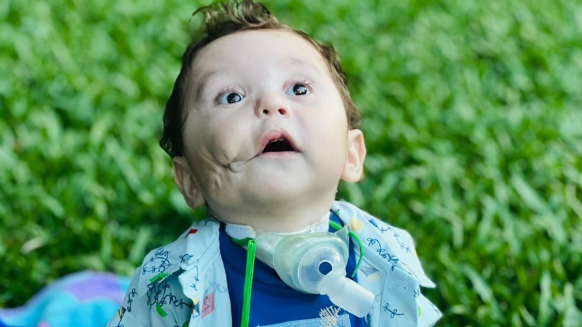 Bebê curitibano que nasceu to tumor no rosto