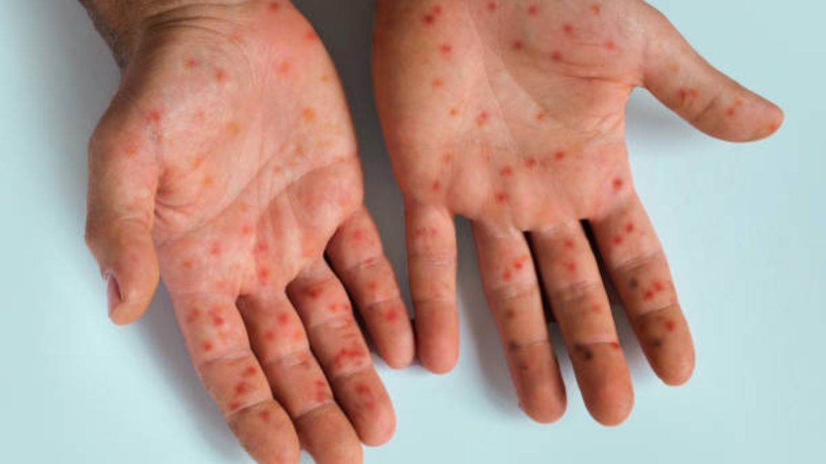 Brasil registra mais de mil casos de Mpox em 2024