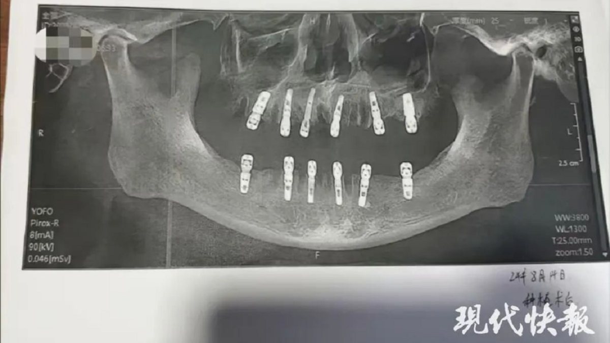 Homem morre 13 dias depois extrair 23 dentes e implantar 12 em cirurgia